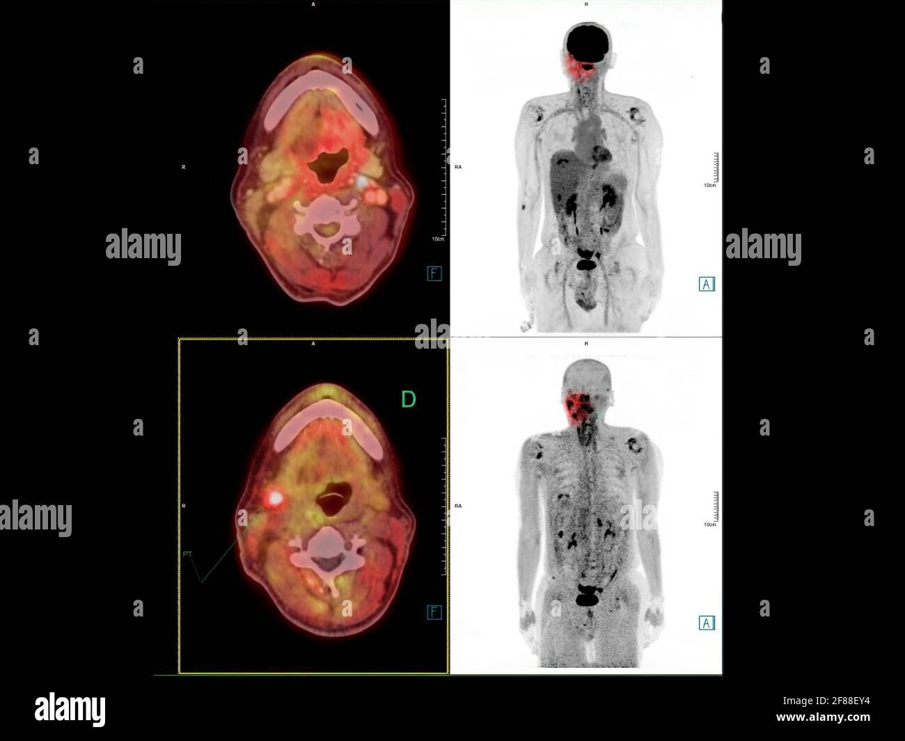 PET-CT-Bild des Halses mit CA Nasopharynx oder Karzinom des Nasopharynx aus PET-CT-Scannern. Stockfoto