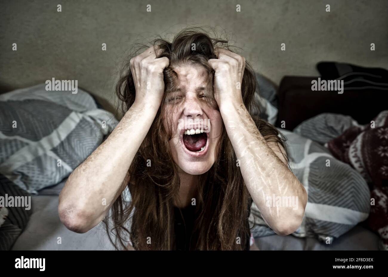 Porträt, Hände und Arme einer Frau, die vor Hysterie und Verzweiflung schreit, mit schweren Schnitten und Narben der Selbstverstümmelung in Frustration, Selbstmissbrauchs, Stockfoto