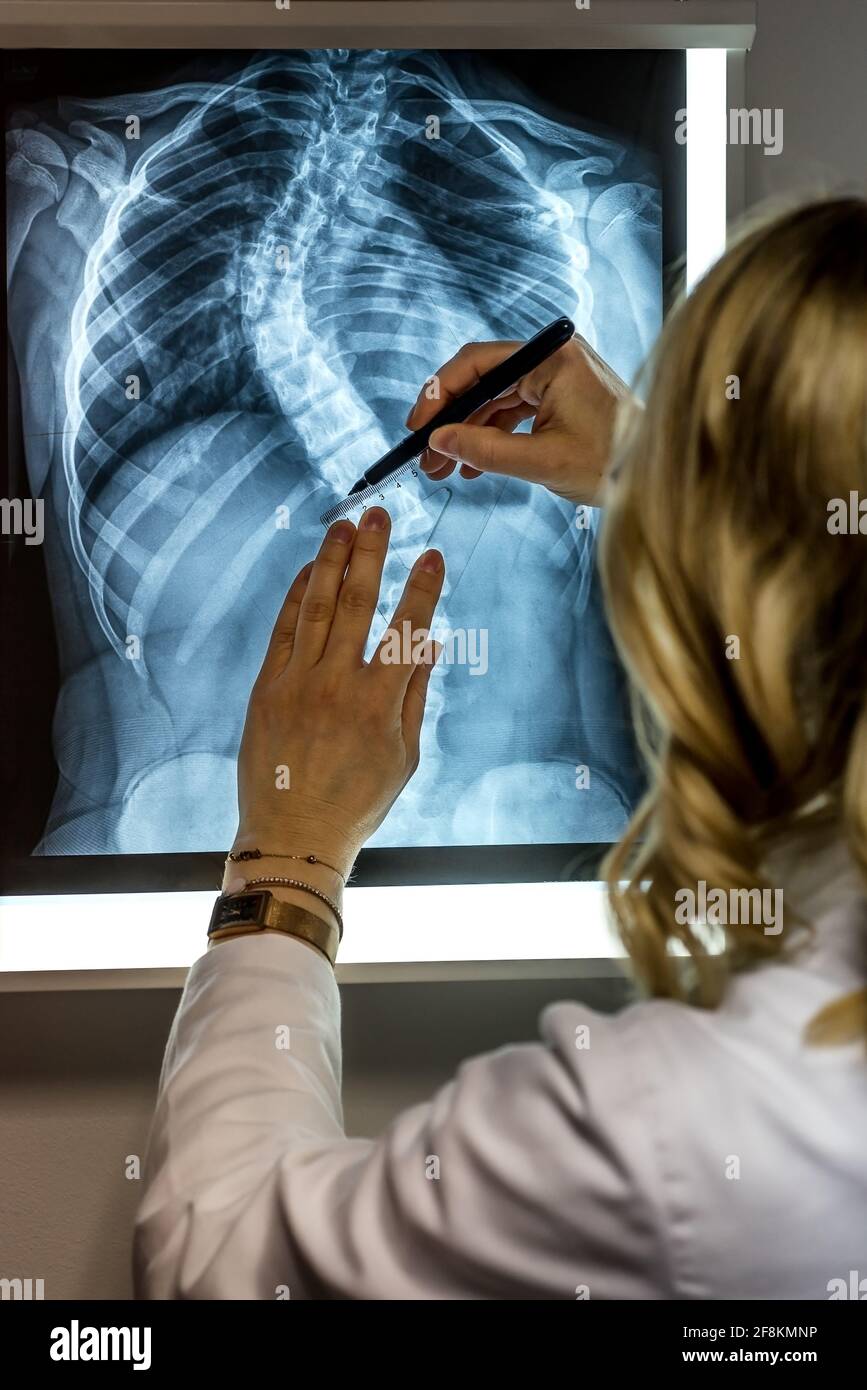 Blonde Ärztin beim Betrachen einer Röntgenaufnahme des Patienten. Skoliose-Spezialist Arzt, der Messungen am Patienten Röntgenaufnahme macht Stockfoto