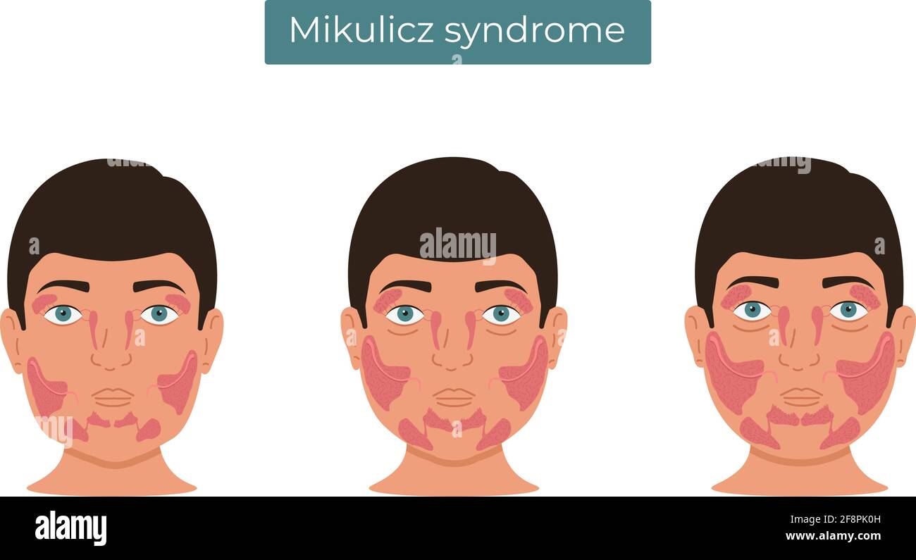 Vektordarstellung des Mikulicz-Syndroms. Vergrößerung der Tränendrüsen und Speicheldrüsen. Stock Vektor