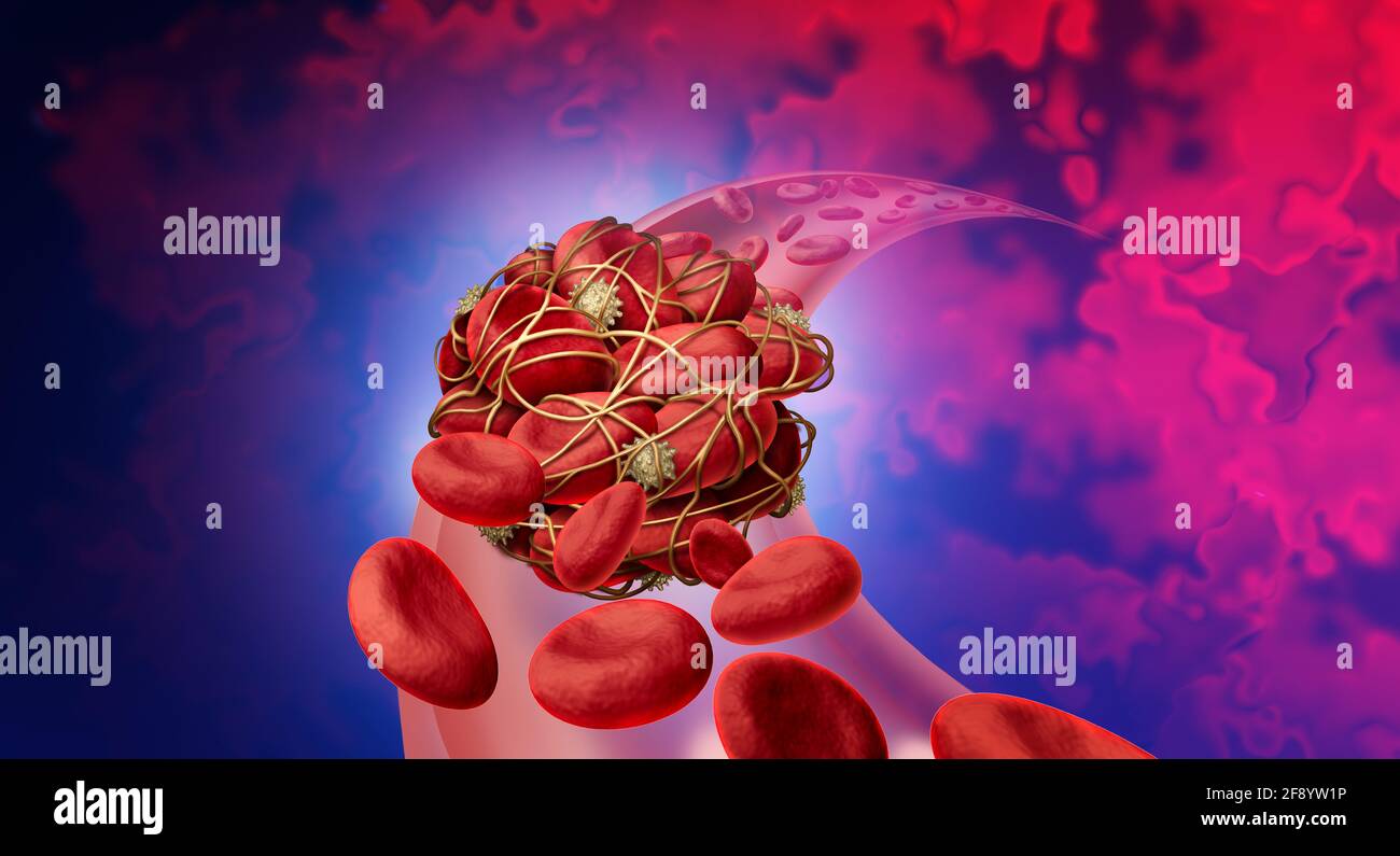 Blutgerinnsel Gesundheitsrisiko oder Thrombose medizinisches Illustrationskonzept Symbol als eine Gruppe von menschlichen Blutzellen, die durch klebrige Thrombozyten zusammengeklemmt werden. Stockfoto