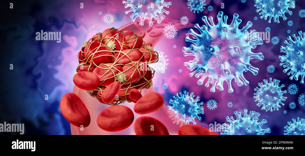 Blutgerinnsel und Virusinfektion sowie Coronavirus oder Influenza als Zellen, die durch klebrige Thrombozyten und Fibrin als Blockade in einer Arterie zusammengeklemmt werden. Stockfoto