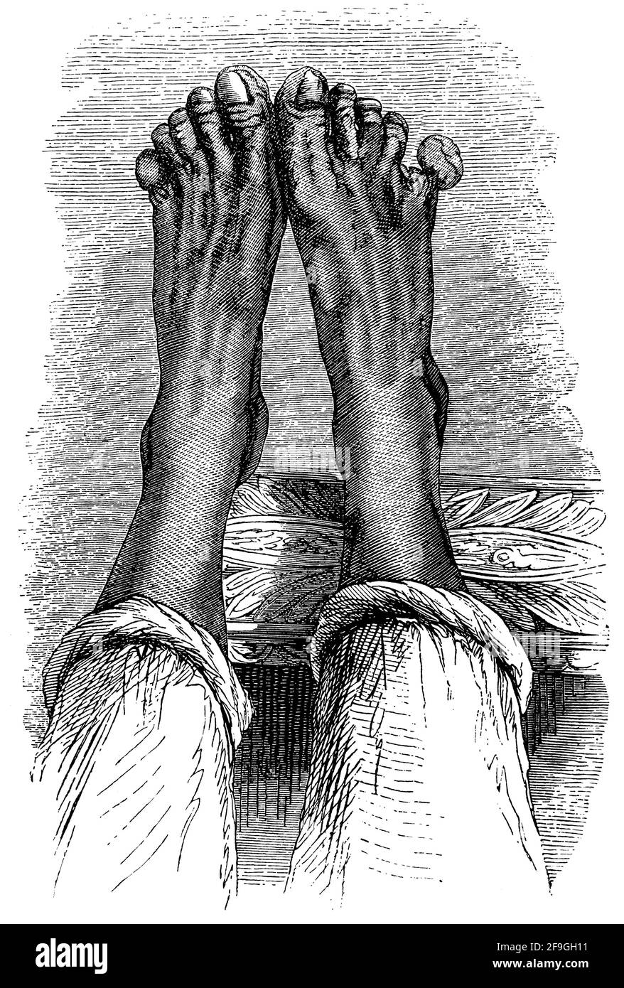 Gangrän der Füße. Illustration des 19. Jahrhunderts. Deutschland. Weißer Hintergrund. Stockfoto