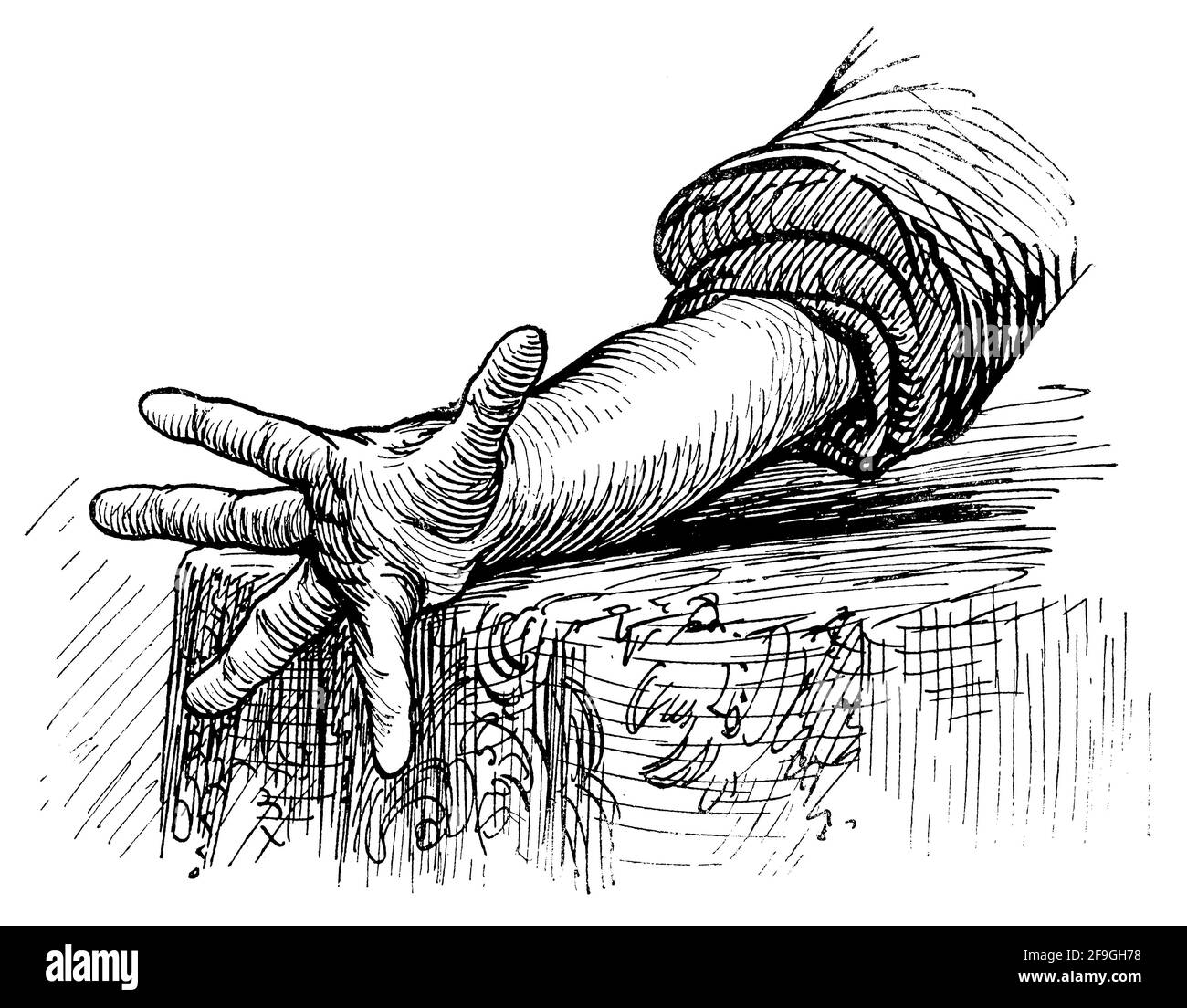 Abnorme Position der Finger der Hand als Folge von psychischen Störungen. Illustration des 19. Jahrhunderts. Deutschland. Weißer Hintergrund. Stockfoto