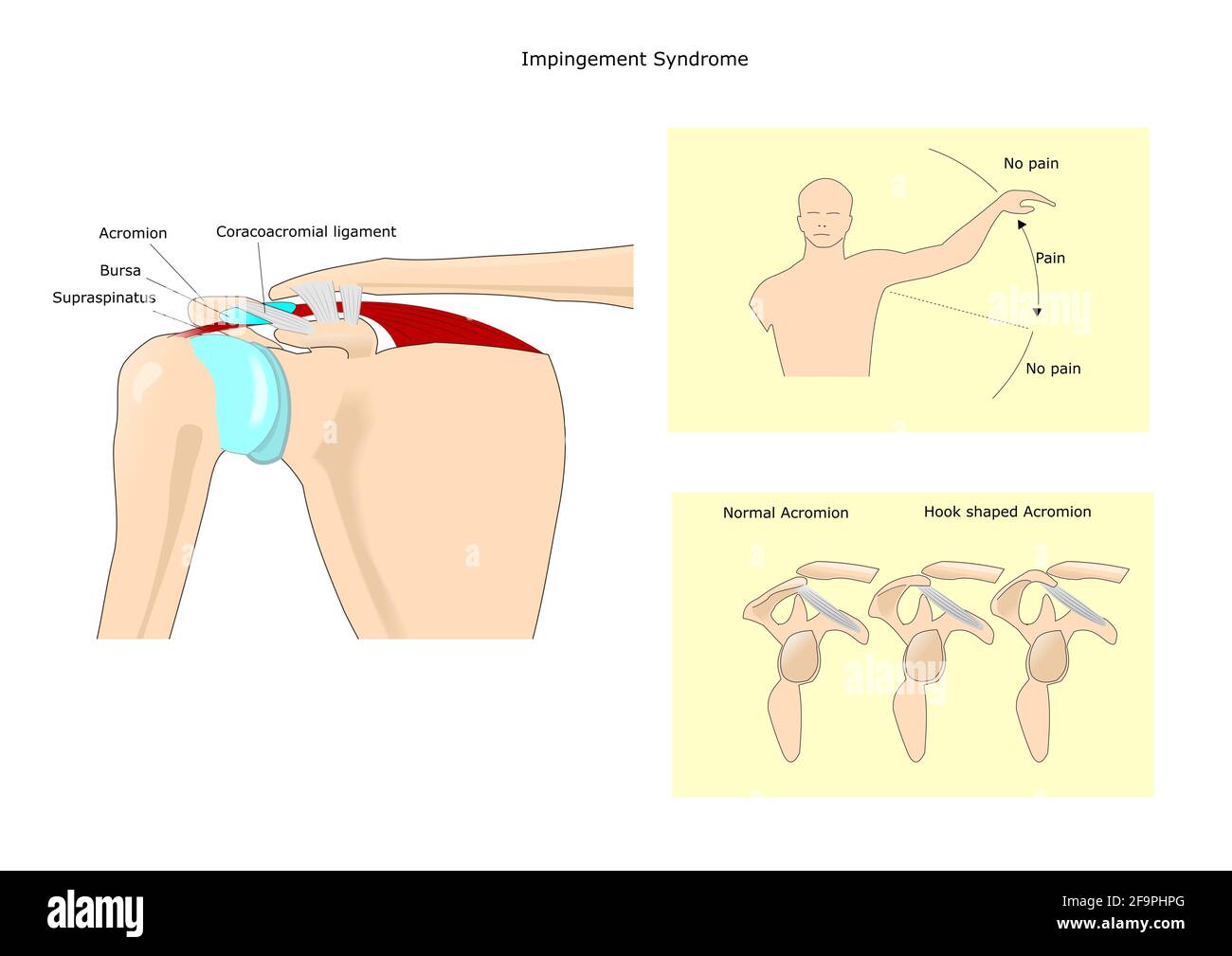Impingement-syndrom Schulter Grad Der Behinderung