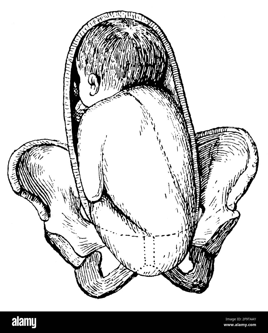 Pathologie während der Geburt. Breech-Position. Illustration des 19. Jahrhunderts. Deutschland. Weißer Hintergrund. Stockfoto