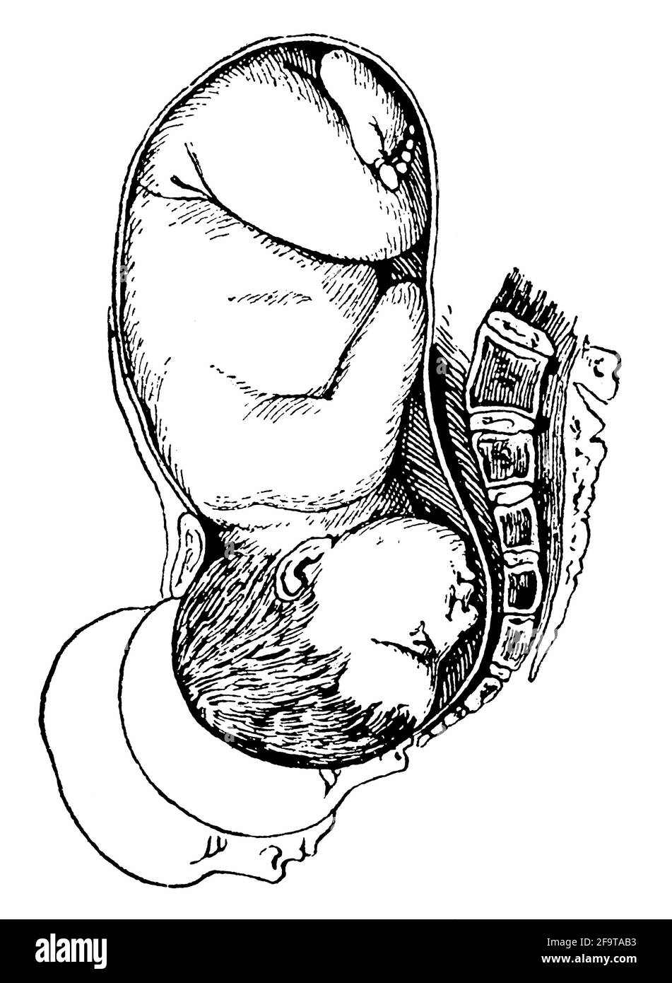 Pathologie während der Geburt. Gesichtsdarstellung. Illustration des 19. Jahrhunderts. Deutschland. Weißer Hintergrund. Stockfoto