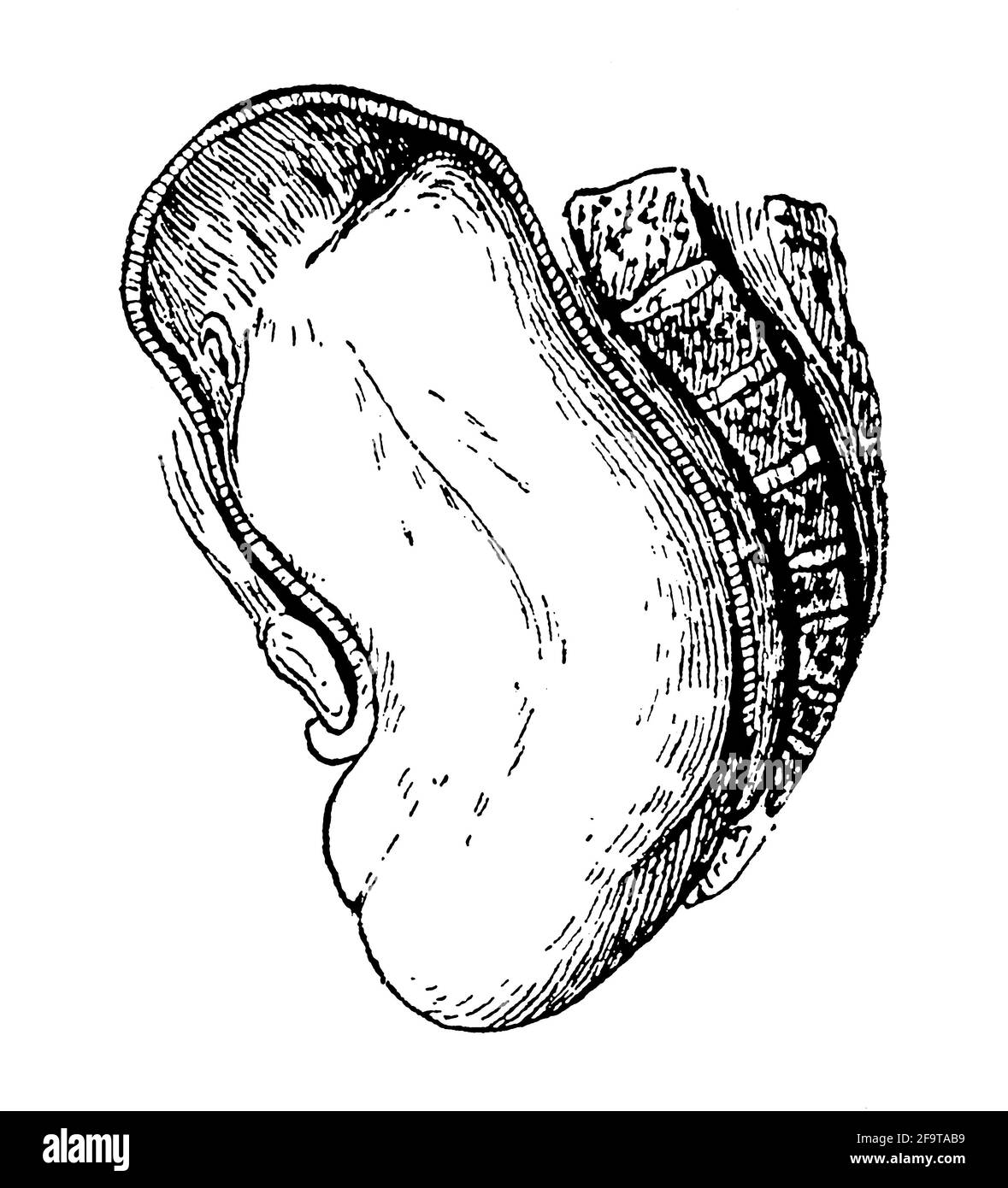 Pathologie während der Geburt. Breech Geburt. Illustration des 19. Jahrhunderts. Deutschland. Weißer Hintergrund. Stockfoto