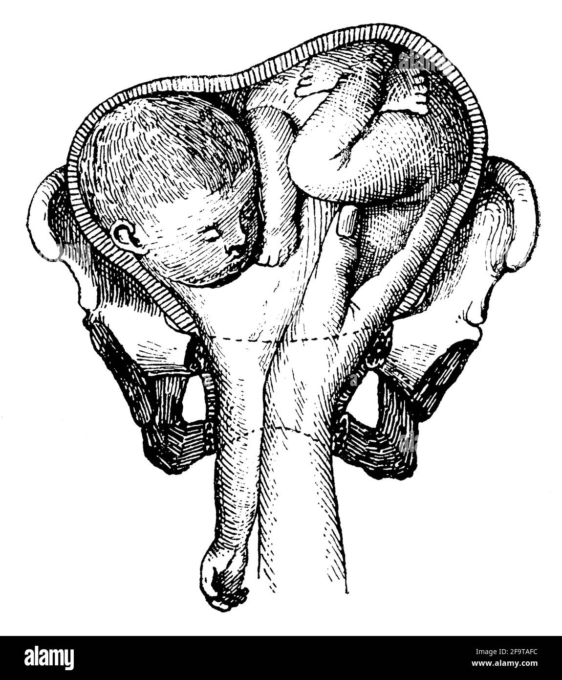 Geburtshilfe in der Pathologie. Schulterpräsentation. Illustration des 19. Jahrhunderts. Deutschland. Weißer Hintergrund. Stockfoto