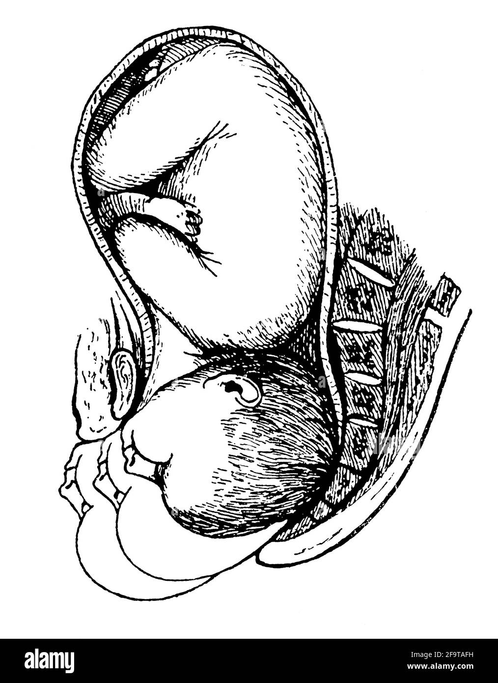 Pathologie während der Geburt. Gesichtsdarstellung. Illustration des 19. Jahrhunderts. Deutschland. Weißer Hintergrund. Stockfoto