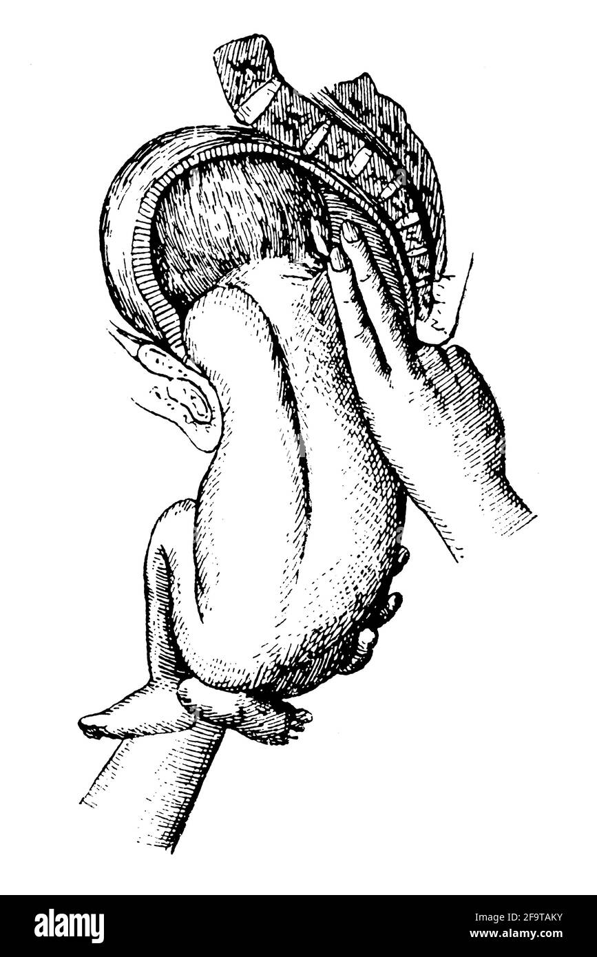 Geburtshilfe. Geburt. Illustration des 19. Jahrhunderts. Deutschland. Weißer Hintergrund. Stockfoto