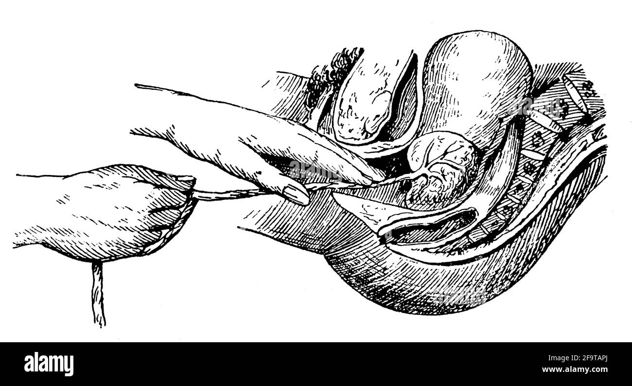 Geburtshilfe. Geburt. Künstliche Entfernung der Plazenta. Illustration des 19. Jahrhunderts. Deutschland. Weißer Hintergrund. Stockfoto