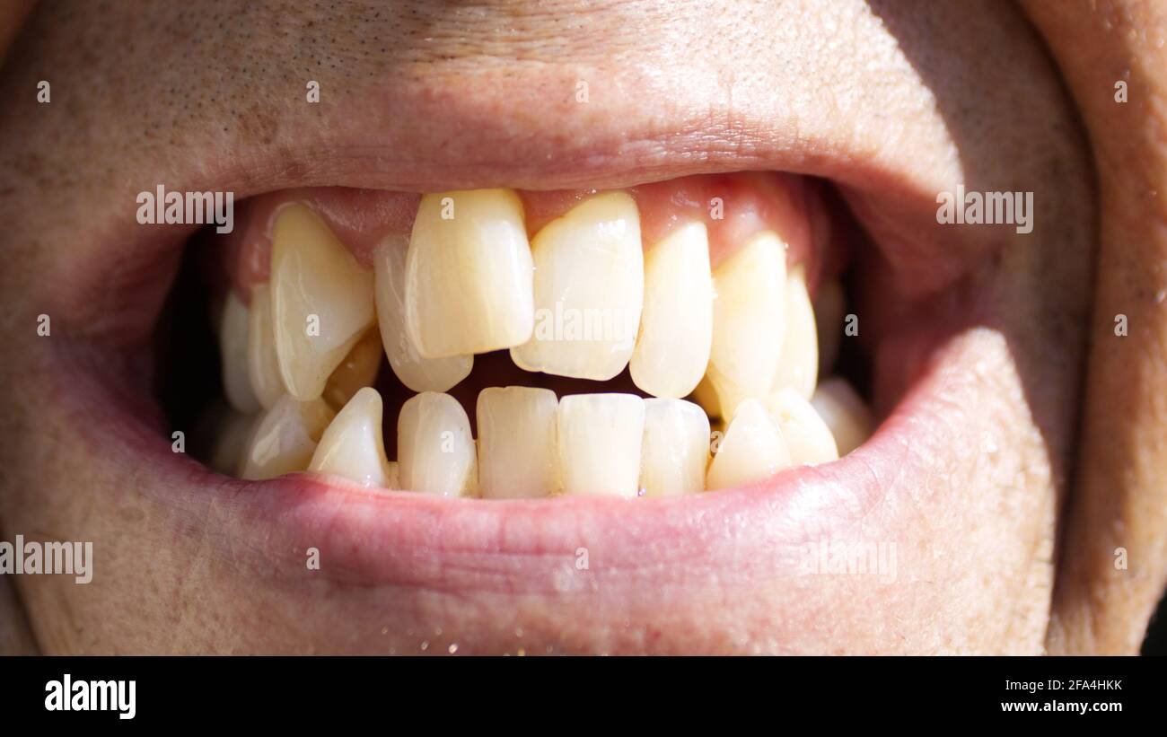 Eine Nahaufnahme von krummen sauberen Zähnen Stockfoto