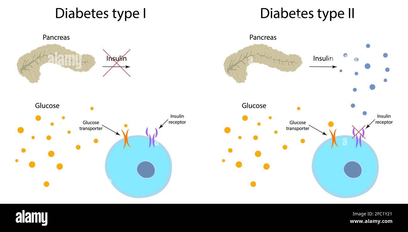 Diabetes Typ 1 und 2, Abbildung Stockfoto