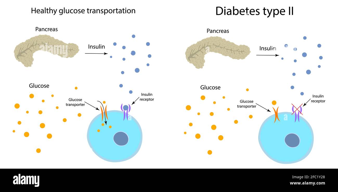 Diabetes Typ 2 und gesunder Glukosestoffwechsel, Illustration Stockfoto