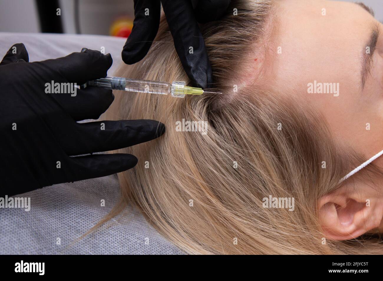 Eine blonde Frau mit gefärbtem Haar leidet unter Haarausfall und erhält Mesotherapie-Injektionen in ihren Kopf. Haarwiederherstellung Konzept Stockfoto