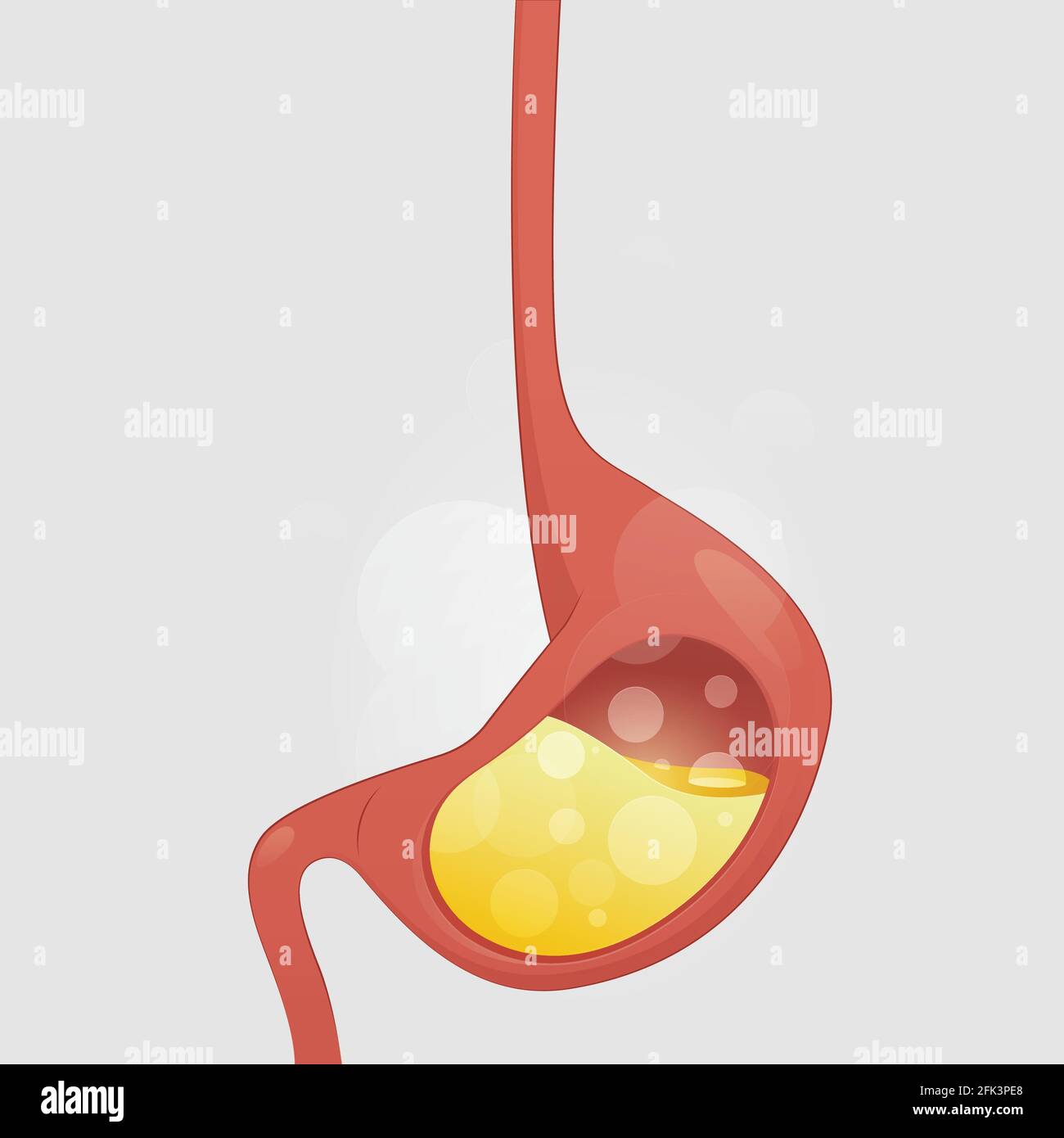 Gastroösophageale Refluxkrankheit, saurer Reflux, Sodbrennen und GERD Infografik mit medizinischer Illustration auf grauem Hintergrund, Cartoon und Vektor Stock Vektor