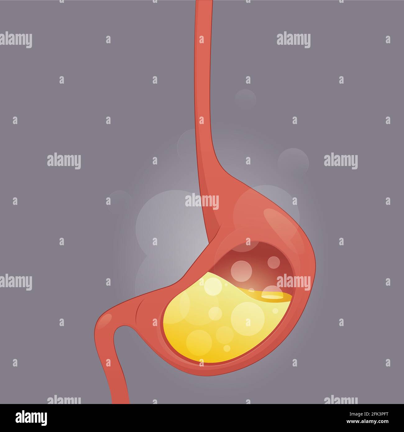 Gastroösophageale Refluxkrankheit, saurer Reflux, Sodbrennen und GERD Infografik mit medizinischer Illustration auf grauem Hintergrund, Cartoon und Vektor Stock Vektor