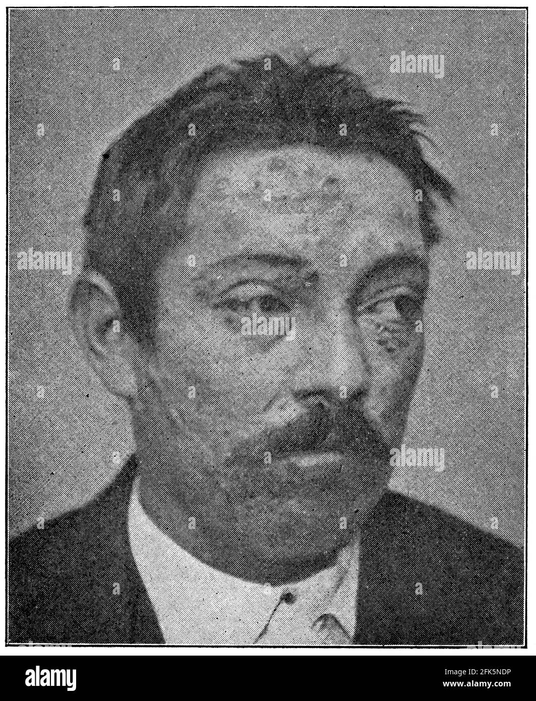 Dieser Patient zeigte sich mit einer bösartigen Syphilis. Illustration des 19. Jahrhunderts. Deutschland. Weißer Hintergrund. Stockfoto