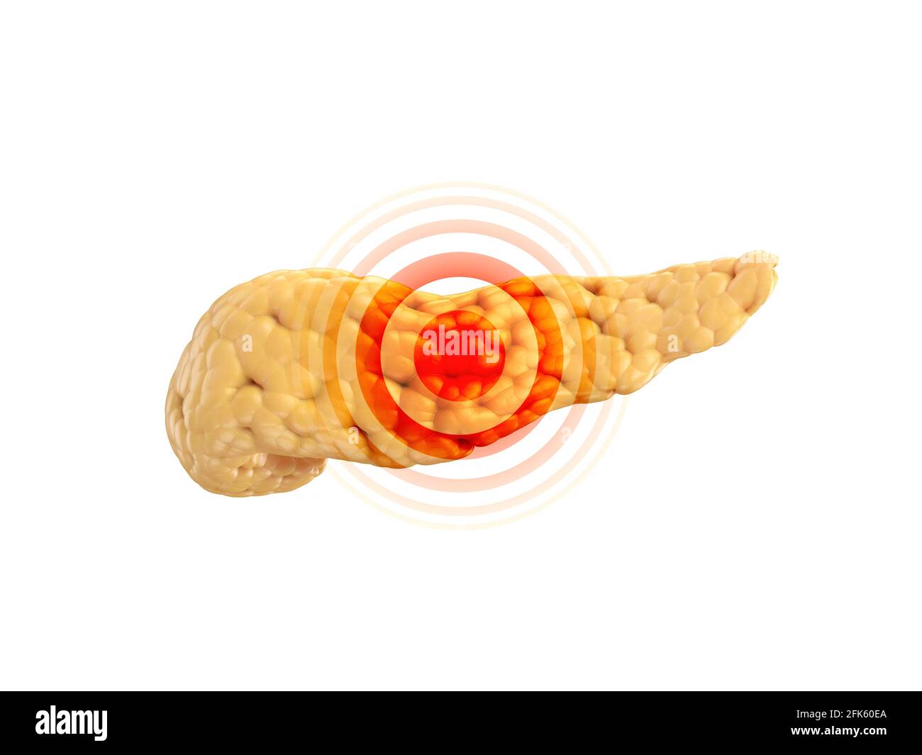 Krankheit oder Schmerz Konzept der menschlichen Bauchspeicheldrüse isoliert auf weiß mit roten Schmerzen Zeichen auf sie. 3d-Illustration Stockfoto
