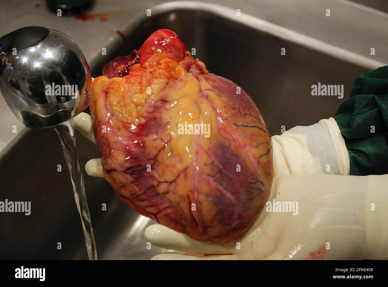 Cardiac hypertrophy Stockfotos und bilder Kaufen Alamy