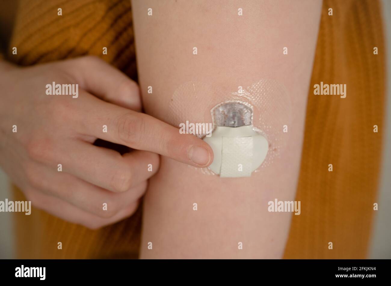 Sensor zur kontinuierlichen Glukoseüberwachung an einem Arm von Diabetes-Patienten Stockfoto