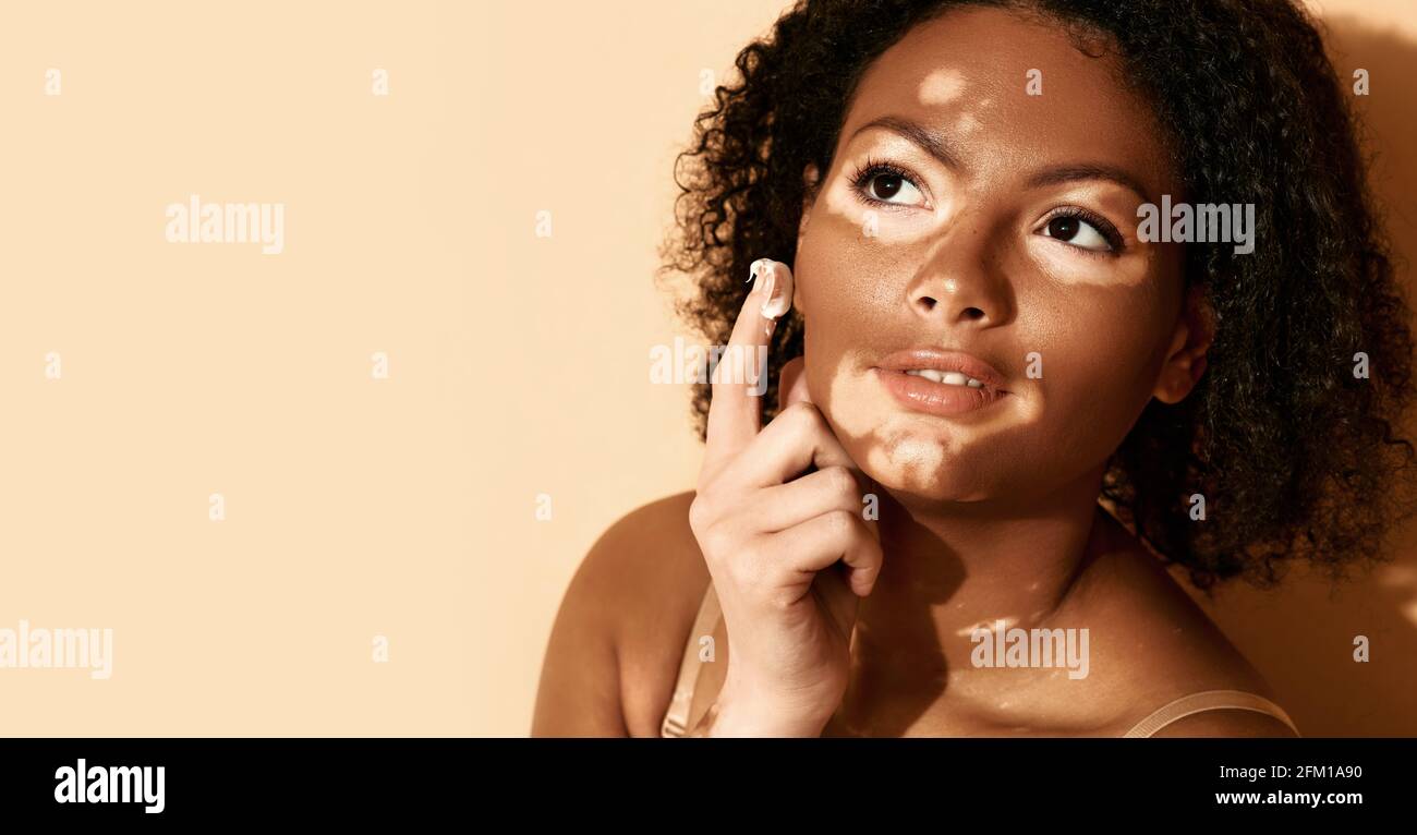 Frau mit Vitiligo trägt feuchtigkeitsspendende Creme auf ihrem Gesicht, auf einem beigen Hintergrund. Gesichtscreme feuchtigkeitsspendende Haut Stockfoto