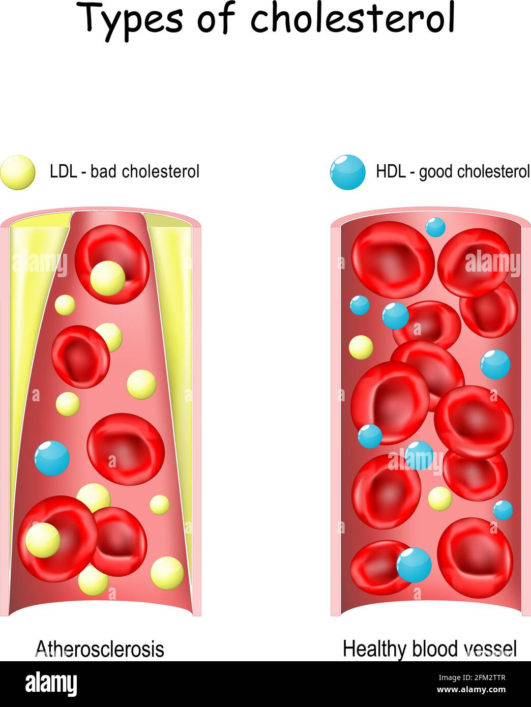 Gutes und schlechtes Cholesterin. Vergleich von HDL und LDL Lipoprotein. Gesunde und verengte Arterie (Atherosklerose). Querschnitt. vektordarstellung Stock Vektor