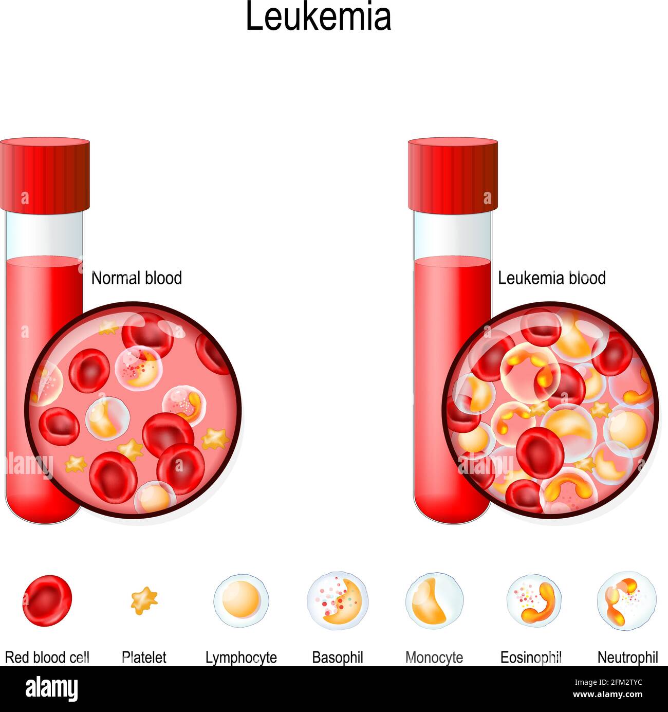 Leukämie. Rote und weiße Blutkörperchen im Reagenzglas. Vergleich und Unterschied zwischen gesundem Blut und Blutkrebs. Nahaufnahme von Erythrozyten, Monozyten Stock Vektor