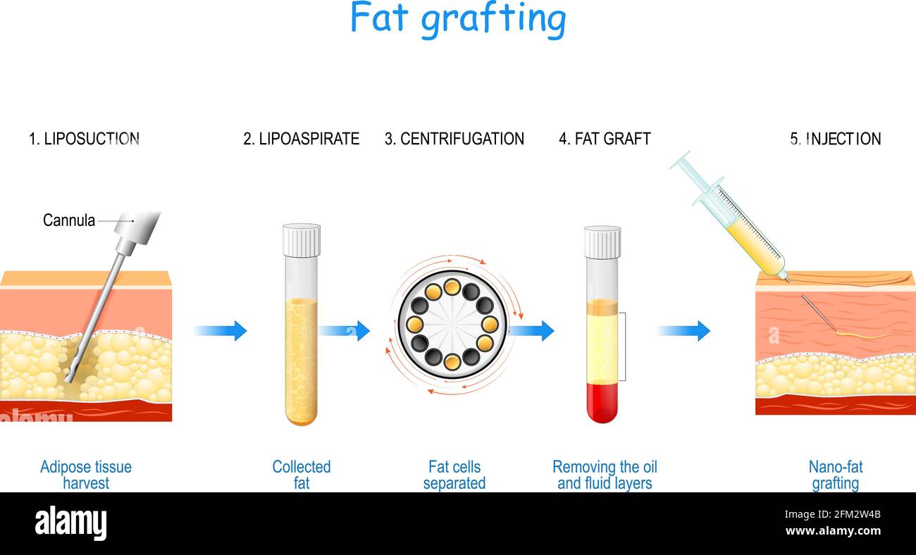 Schritte der Fetttransplantation: Von der Fettabsaugung (Fettgewebeernte und -Sammlung) bis zur Zentrifugation für abgetrennte Fettzellen und Entfernung von Öl und Flüssigkeit Stock Vektor Schritte der Fetttransplantation: Von der Fettabsaugung (Fettgewebeernte und -Sammlung) bis zur Zentrifugation für abgetrennte Fettzellen und Entfernung von Öl und Flüssigkeit Stock Vektor