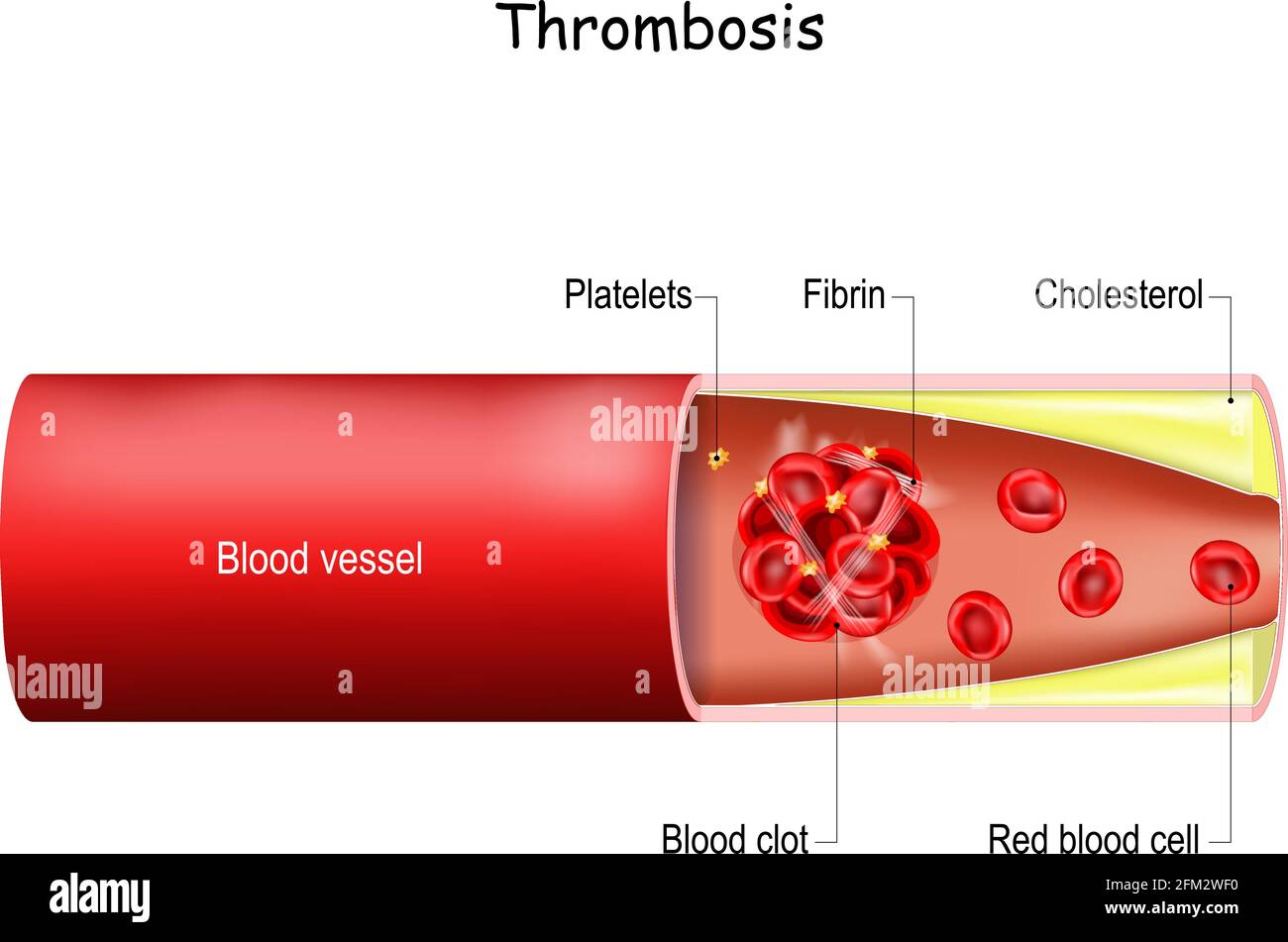 Thrombose. Blutgerinnsel in einem Blutgefäß (Arterie oder Vene). Gesundheitsproblem. Vektorgrafik für den medizinischen Einsatz. Stock Vektor