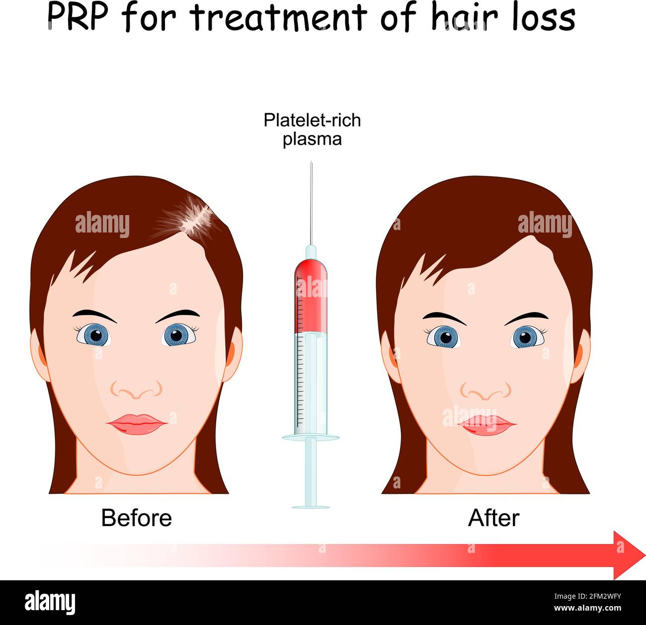 Thrombozytenreiches Plasma. PRP-Verfahren zur Behandlung von Haarausfall. Frau mit Alopezie vor und nach der Injektion. Stock Vektor