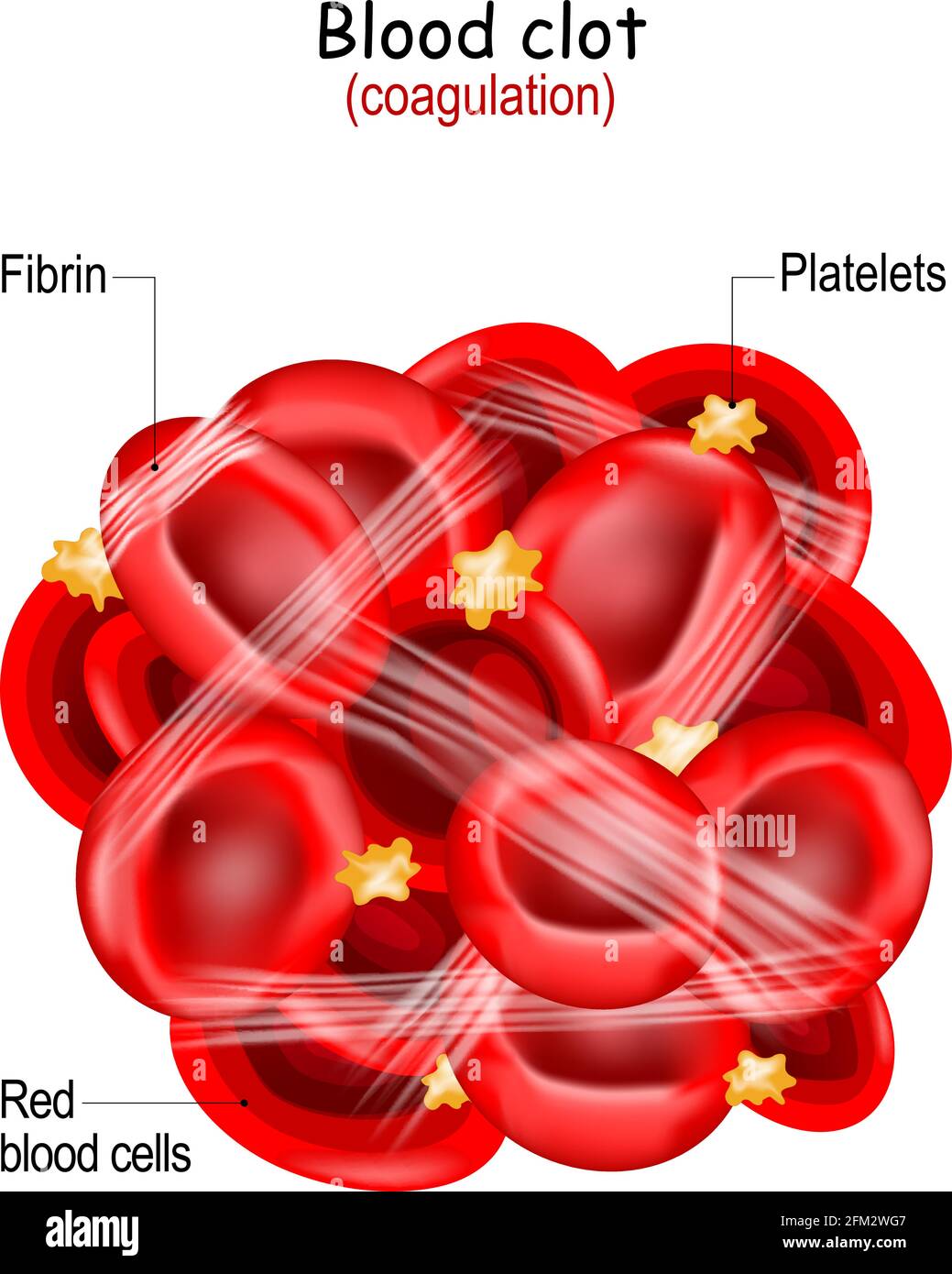 Struktur des Blutgerinnsels. Gerinnung und Gerinnung. Hämostase. Thrombus Stock Vektor
