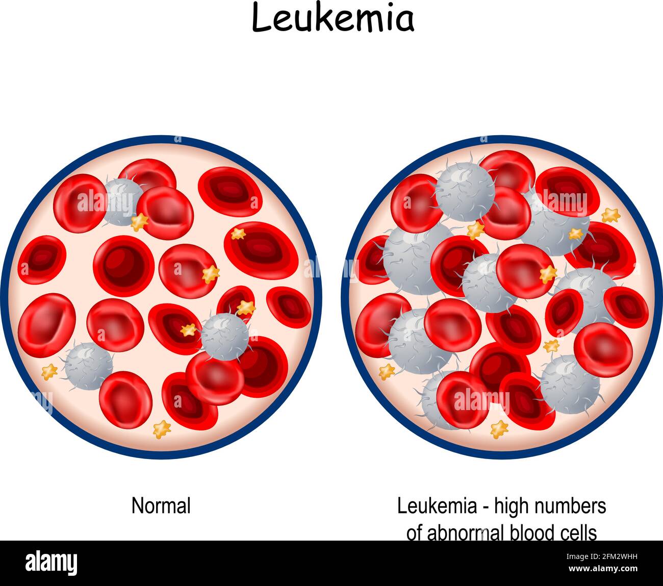 Leukämie. Vergleich und Unterschied zwischen Blut gesunder Menschen und Blutkrebs. Nahaufnahme des Blutgefäßes mit Erythrozyten, Blutplättchen Stock Vektor