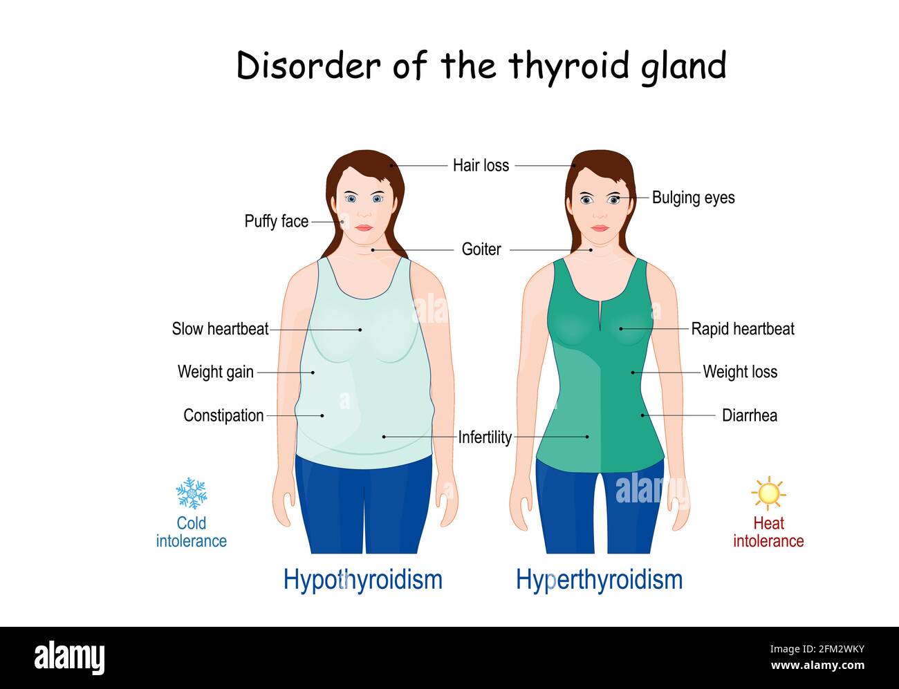 Schilddrüsenstörung. Vergleich und Unterschied zwischen Hyperthyreose und Hypothyreose. Anzeichen und Symptome Stock Vektor