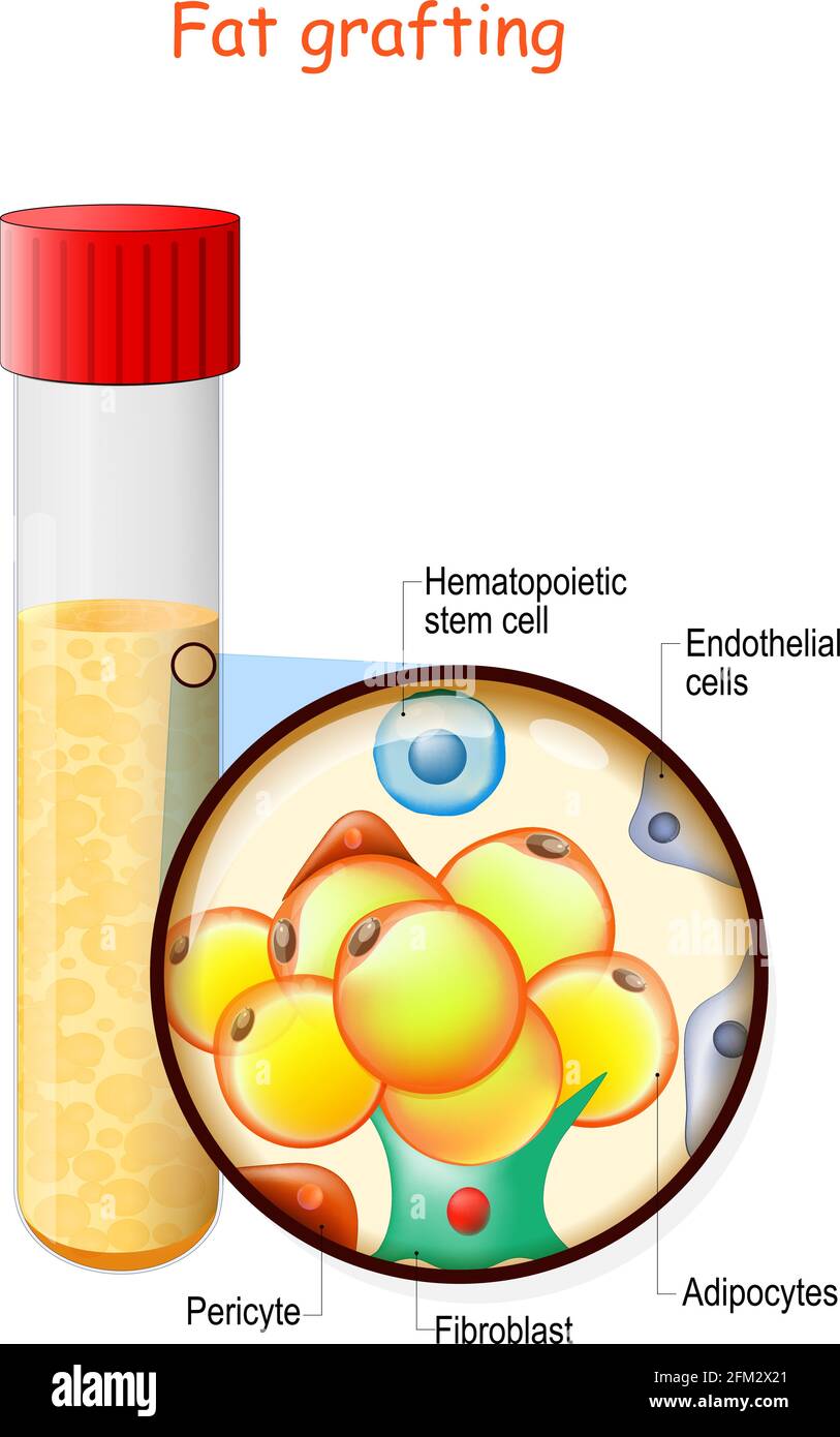 Fetttransplantation Struktur. Reagenzglas mit Fett testen. Nahaufnahme von Adipozyten, Fibroblast, Pericyte, endothelialen und hämatopoetischen Stammzellen. Vektor Stock Vektor