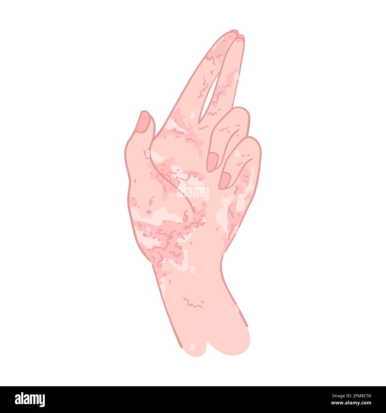 Frau Hand mit Ekzem in Hand gezeichnet Stil. Hautdermatitis oder Allergie - Vektor isoliert Kunst Rötung Handflächenausschlag, Entzündung und Schuppung Stock Vektor