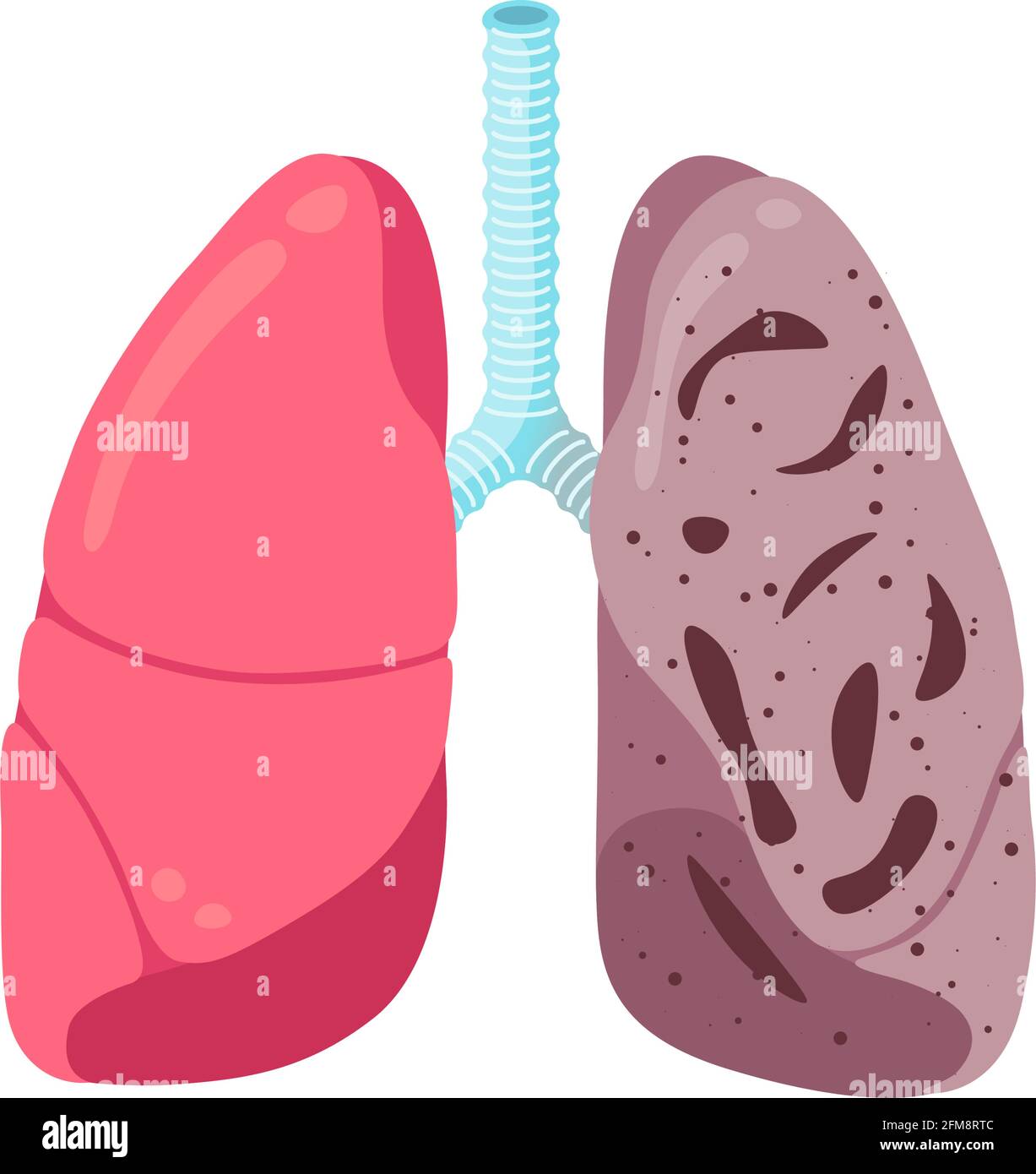 Krank ungesunde Lungen Tuberkulose-Infektion Krankheit. Infektion mit internem Organtubercle Bacillus des menschlichen Atmungssystems oder Lungenentzündung. Medizinische Anatomie Entzündungsschäden Vektor Illusrtation Stock Vektor