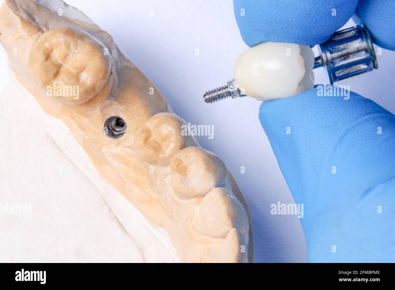 Die Hand des Zahnarztes hält eine Keramikkrone zur Fixierung auf dem Implantat. Zahnmodell mit Zahnimplantat Stockfoto