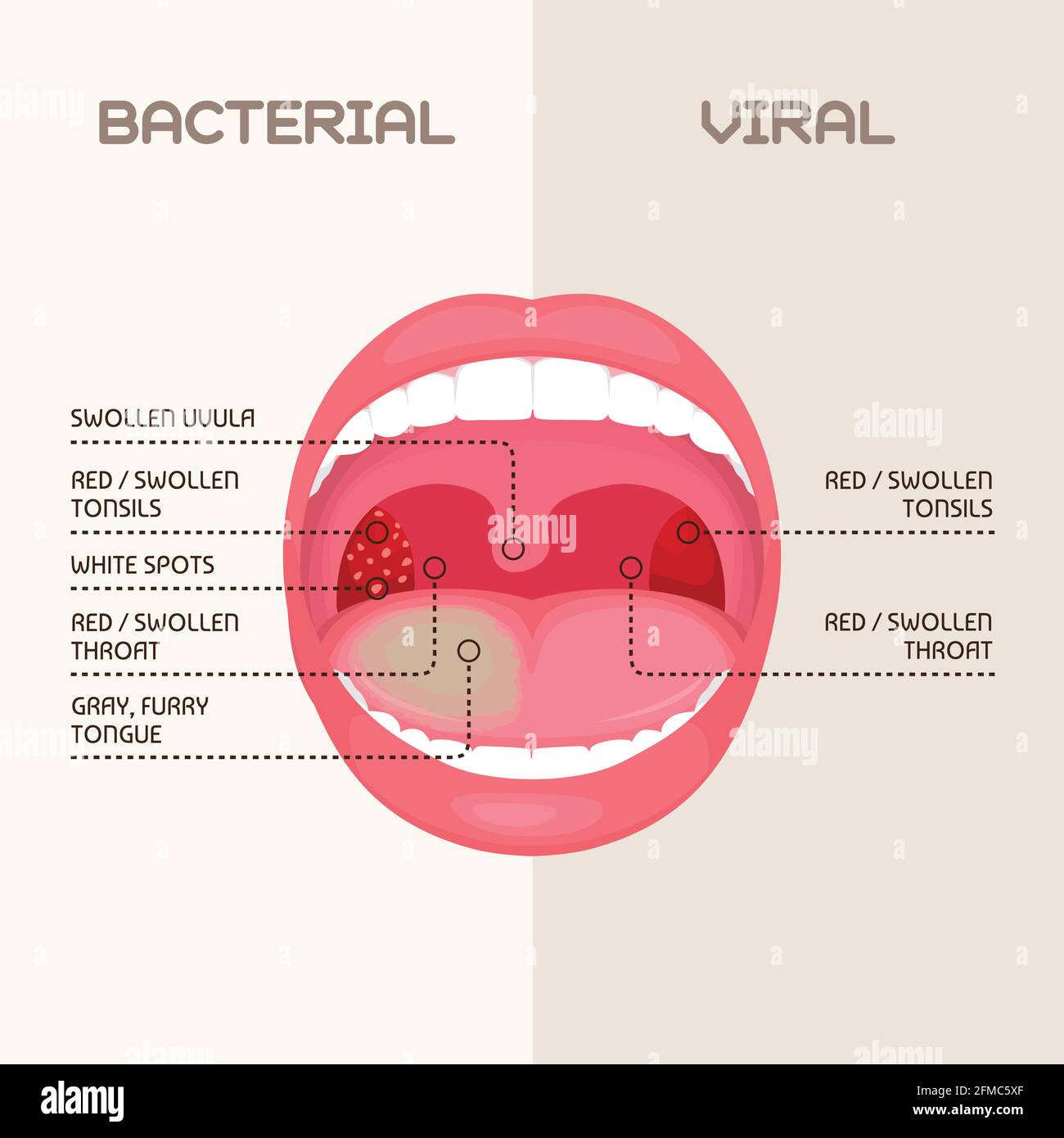 vektor-Illustration einer Kehle bakterielle und virale Infektion, Mandeln Entzündung. Stock Vektor