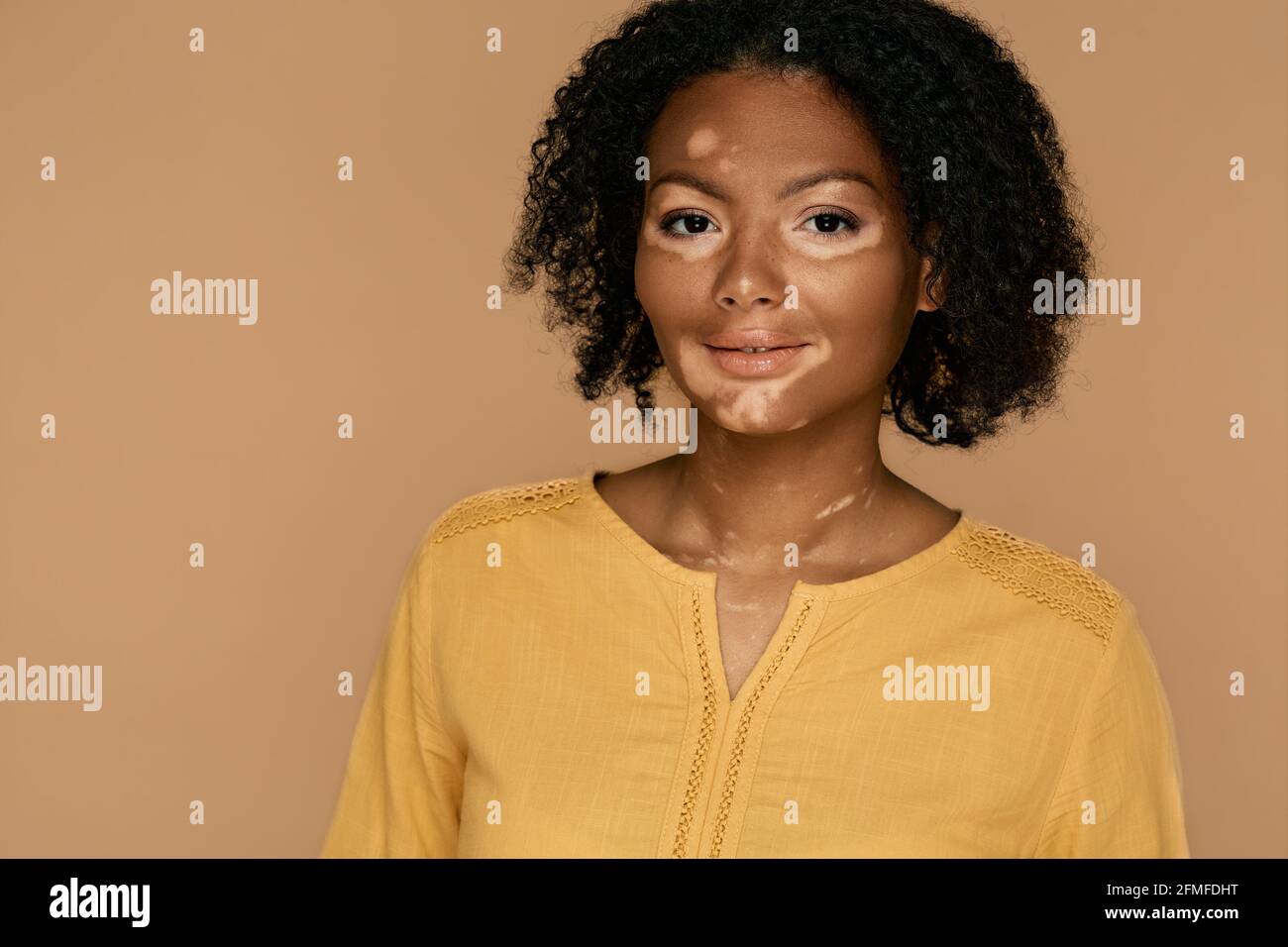 Vitiligo. Positive Frau mit Vitiligo und abnormalen Hautflecken