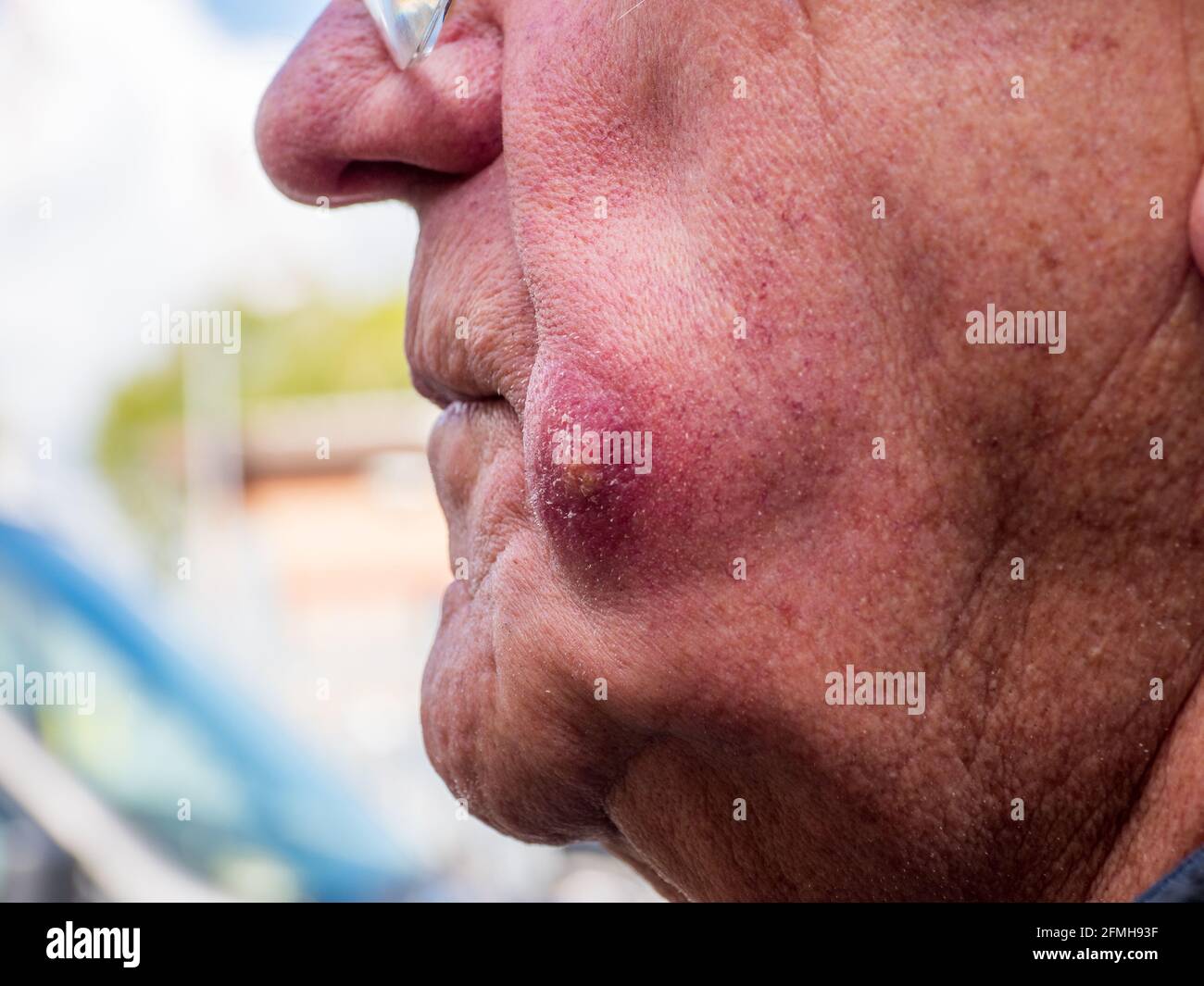 Abszess auf der Seite eines mans-Gesichts Stockfoto