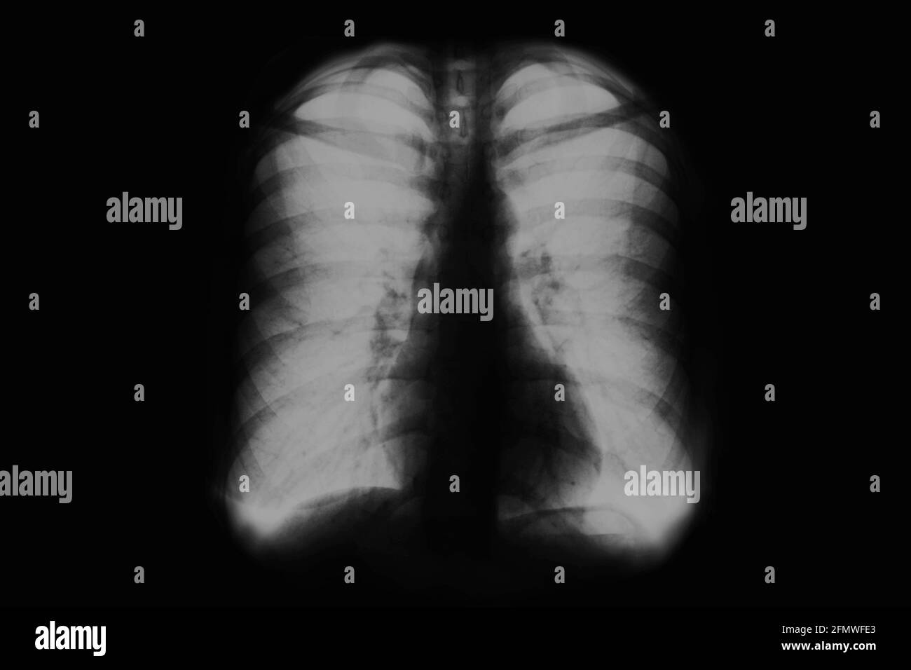Röntgenfilm der menschlichen Brust. Röntgenaufnahme der Lunge von Menschen. Schwarzweiß-Bild Stockfoto
