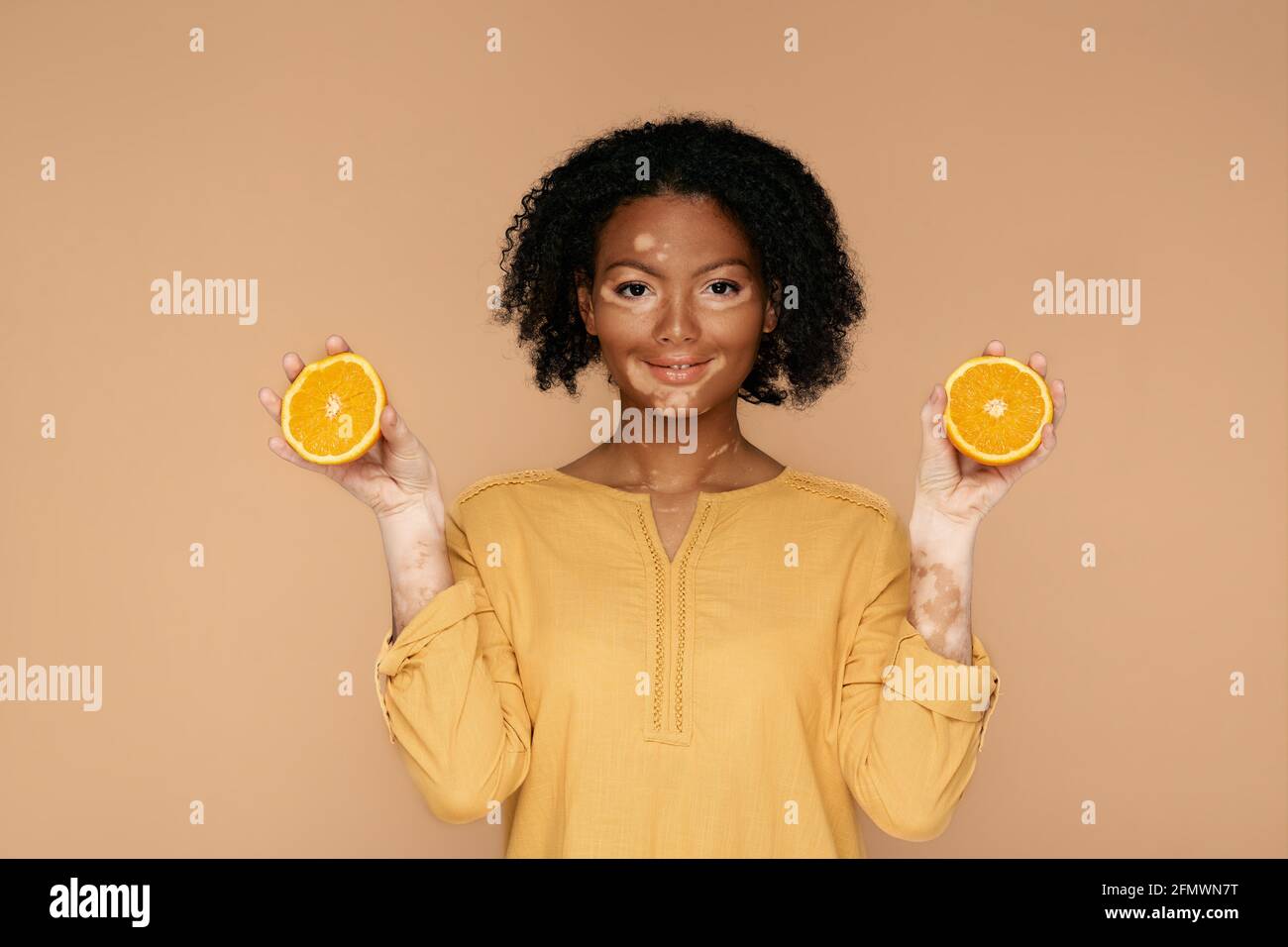 Schönheit, Kosmetik. Frau mit problematischer Haut und Vitiligo hält Orangen in den Händen. Kosmetik mit Vitamin C für die Haut Stockfoto