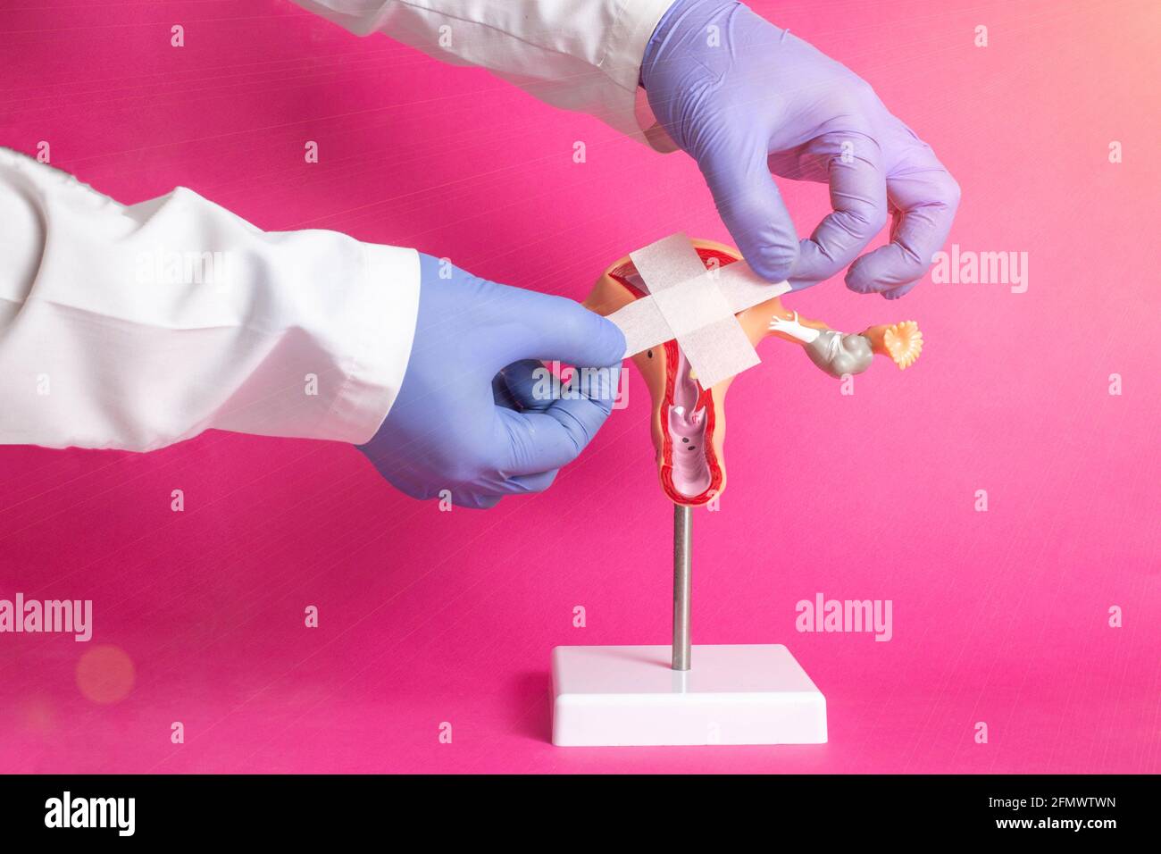 Der Arzt hält einen medizinischen Pflaster in der Nähe des Modells des gynäkologischen Systems des Mädchens auf einem rosa Hintergrund. Sexuell Übertragbare Krankheiten Behandlung Conc Stockfoto