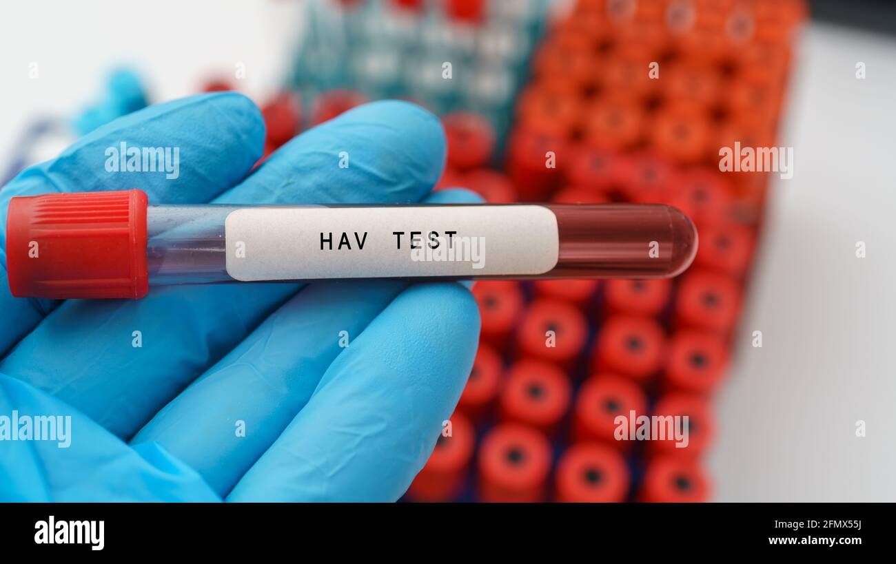 Hepatitis-A-Virus (HAV)-Testergebnis mit Blutprobe in Reagenzglas in ärztlicher Hand im medizinischen Labor Stockfoto