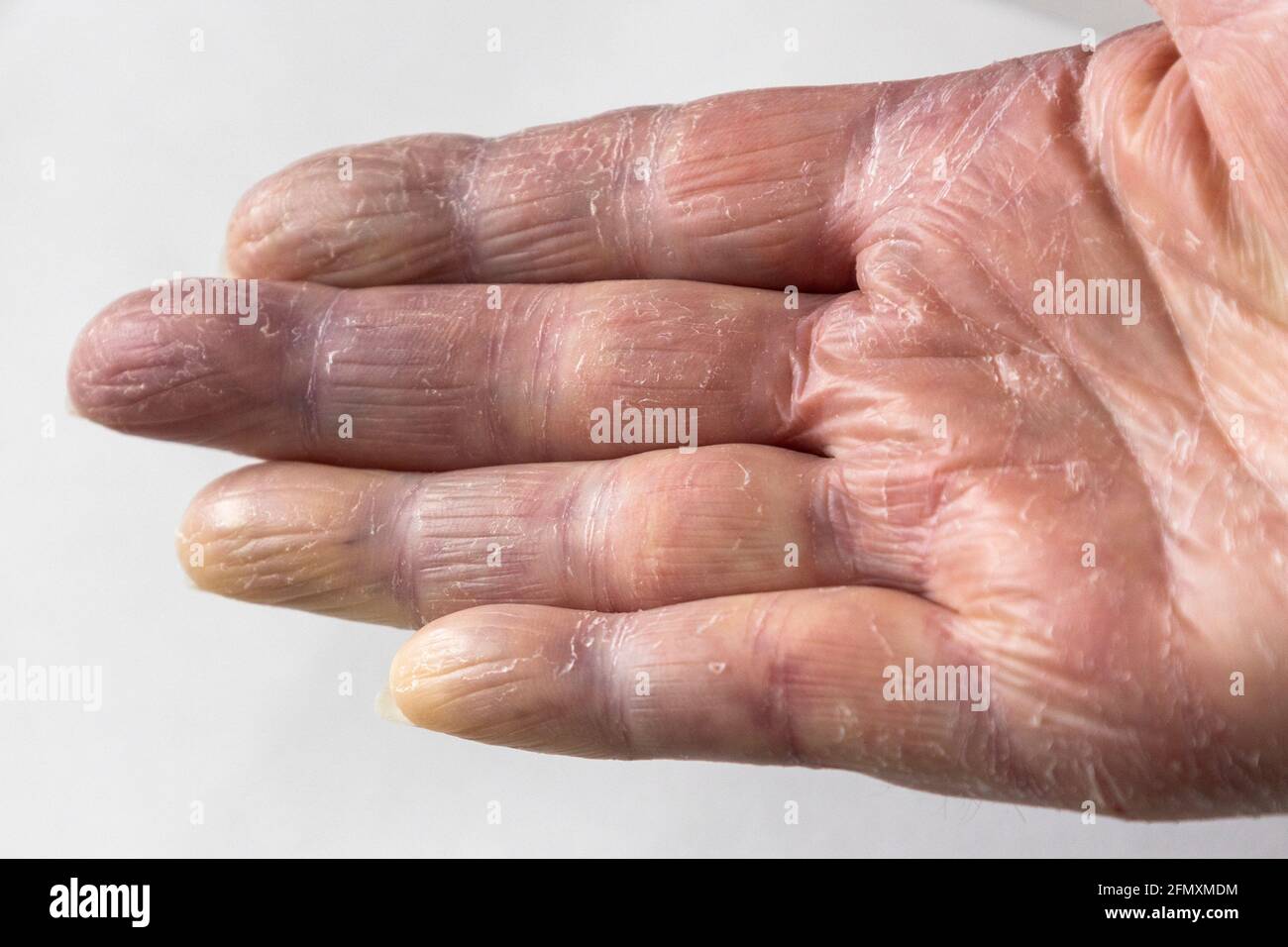 Ältere Dame Hand leiden mit Kreislaufproblemen der blauen und gelben Farbe aufgrund von gesundheitlichen Komplikationen sowie konsequente Nutzung von heißem Wasser. Stockfoto