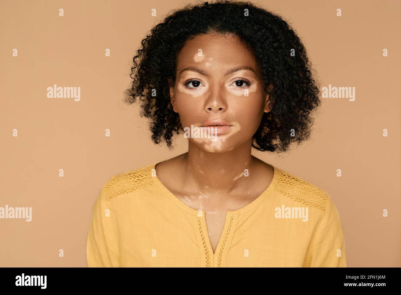 Hautanomalien. Hautpflege mit Vitiligo und abnorme Flecken menschlichen Körper, weibliche Porträt Stockfoto