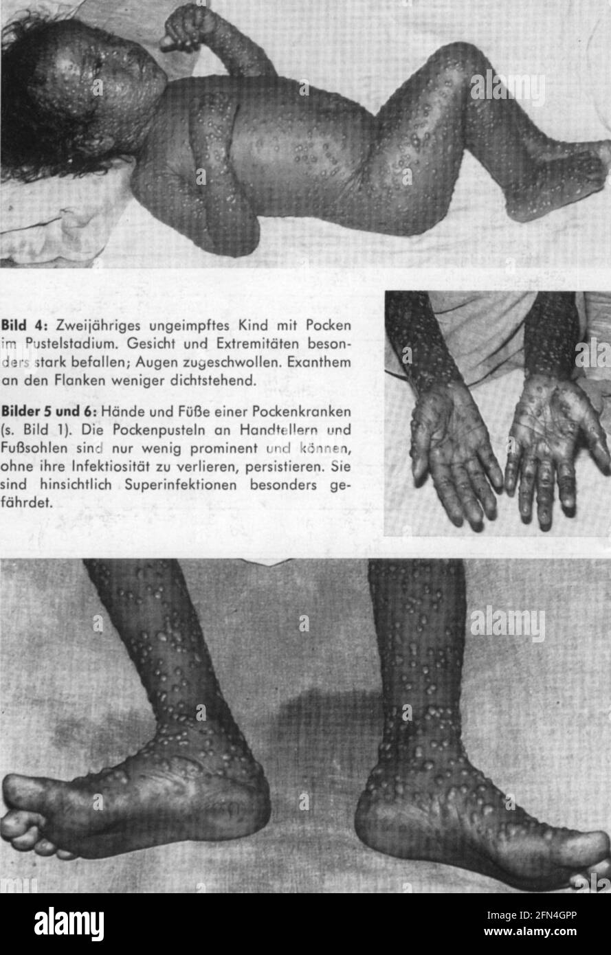 Medizin, Pandemieerkrankungen, Pocken, 2-jähriges Kind in Pustelphase, historisch, historisch, ZUSÄTZLICHE RECHTE-CLEARANCE-INFO-NOT-AVAILABLE Stockfoto