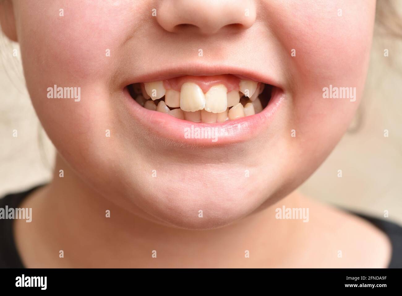 Schiefe Zähne bei einem Mädchen Stockfoto